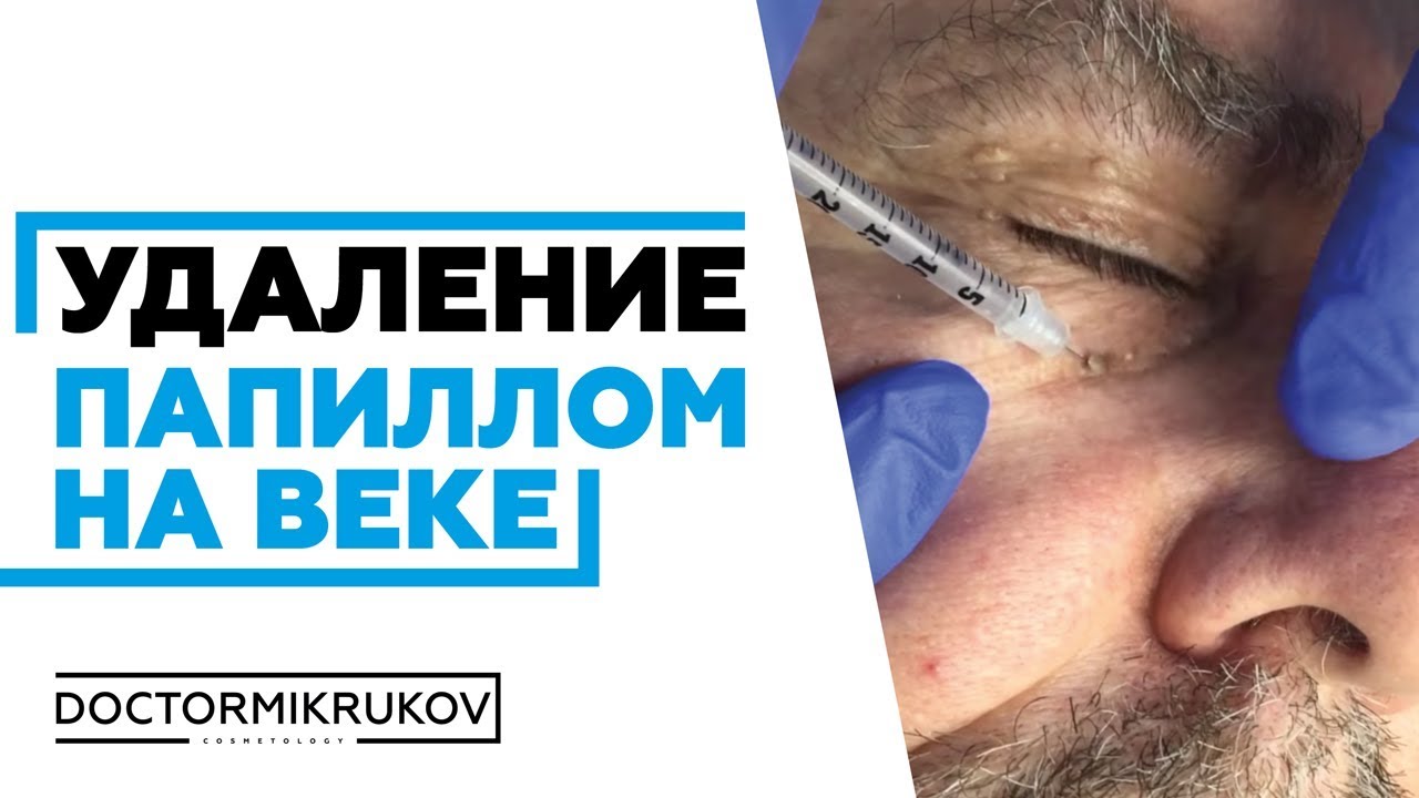 Удаление папиллом в курске цены и адреса