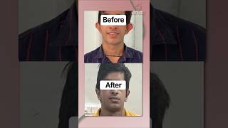 Otoplasty (Bat Ear) Transformation | Ear Correction | Plastic Surgery