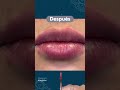 Hidratación y moldeamiento de labios