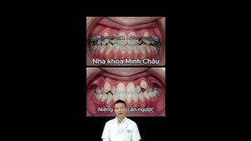 Tình Trạng Răng Lệch Lạc | Bác Sĩ Yên