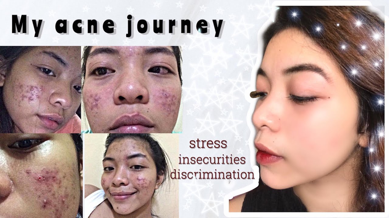 HOW I GOT RID OF MY ACNE | acne journey by Blessie Glaze - YouTube