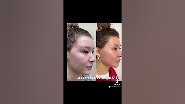 Face Lift Before & 5 Days After | Make Me Over