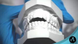AcceleDent Mouthpieces