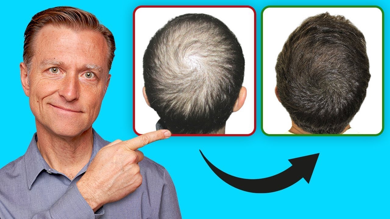 How to Regrow Your Hair (UPDATED VITAL INFO) -Dr Eric Berg