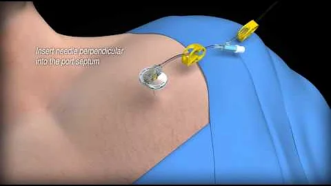 SafeStep Huber Needle Set  Port Access Needles  Bard Access Systems