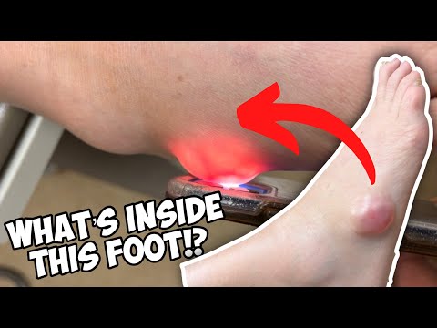Look what was in this foot?! 😱 Dr. Nick Campitelli