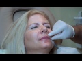 Fuller Lips - Pouty Lip Look - Lip Augmentation