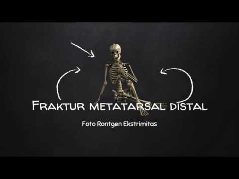 Video: Patah Tulang Metatarsal Kaki