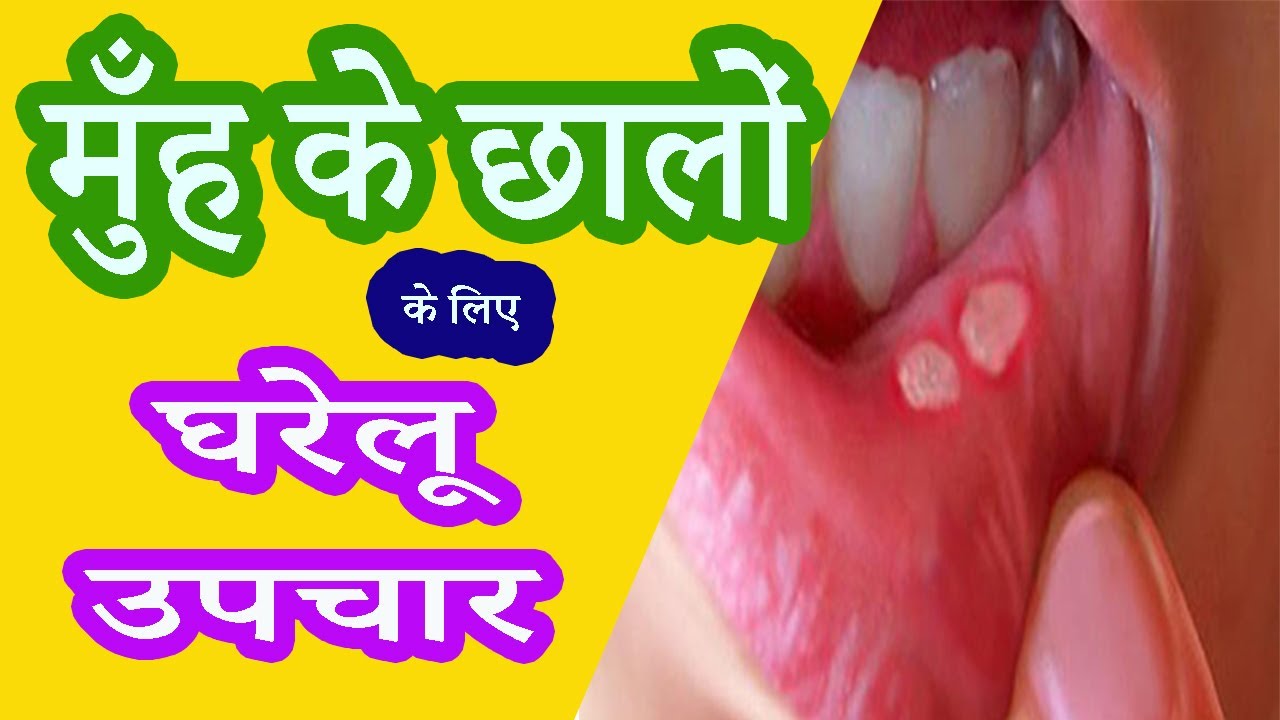 मुँह के छाले का घरेलू ईलाज Mouth Ulcer Treatment Rajnish Tiwary Ayurvedic YouTube