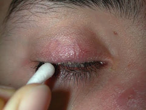 Paglinis ng Mata at Hilamos, Iwas Kuliti at Impeksyon – ni Doc Yul Dorotheo (Eye Doctor) #6