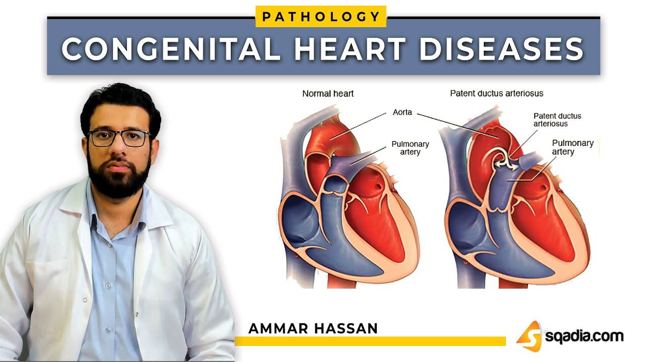 Congenital Heart Diseases | Introduction and Classification | Pathology ...