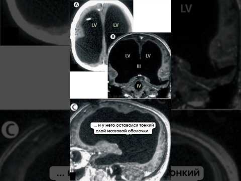 Можно ли прожить без мозга