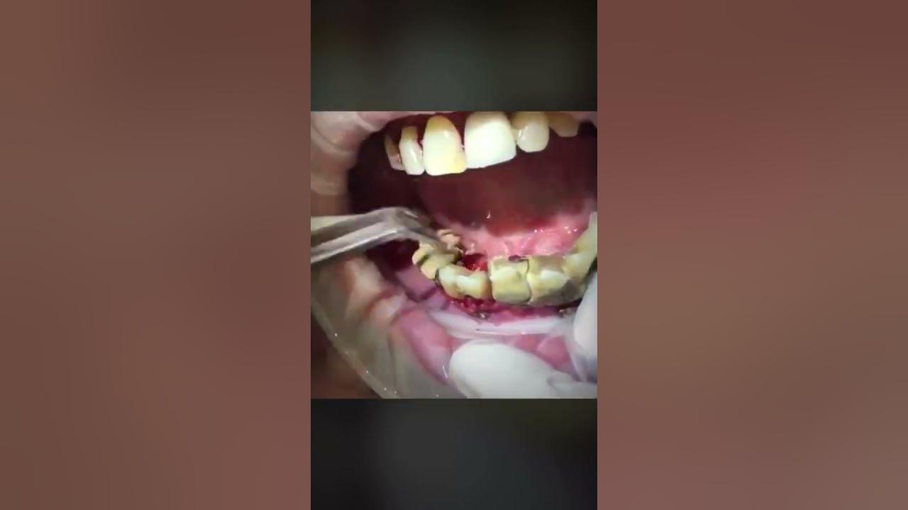 Super Satisfying Blackhead Removal / Satisfying With Loan Nguyen Spa