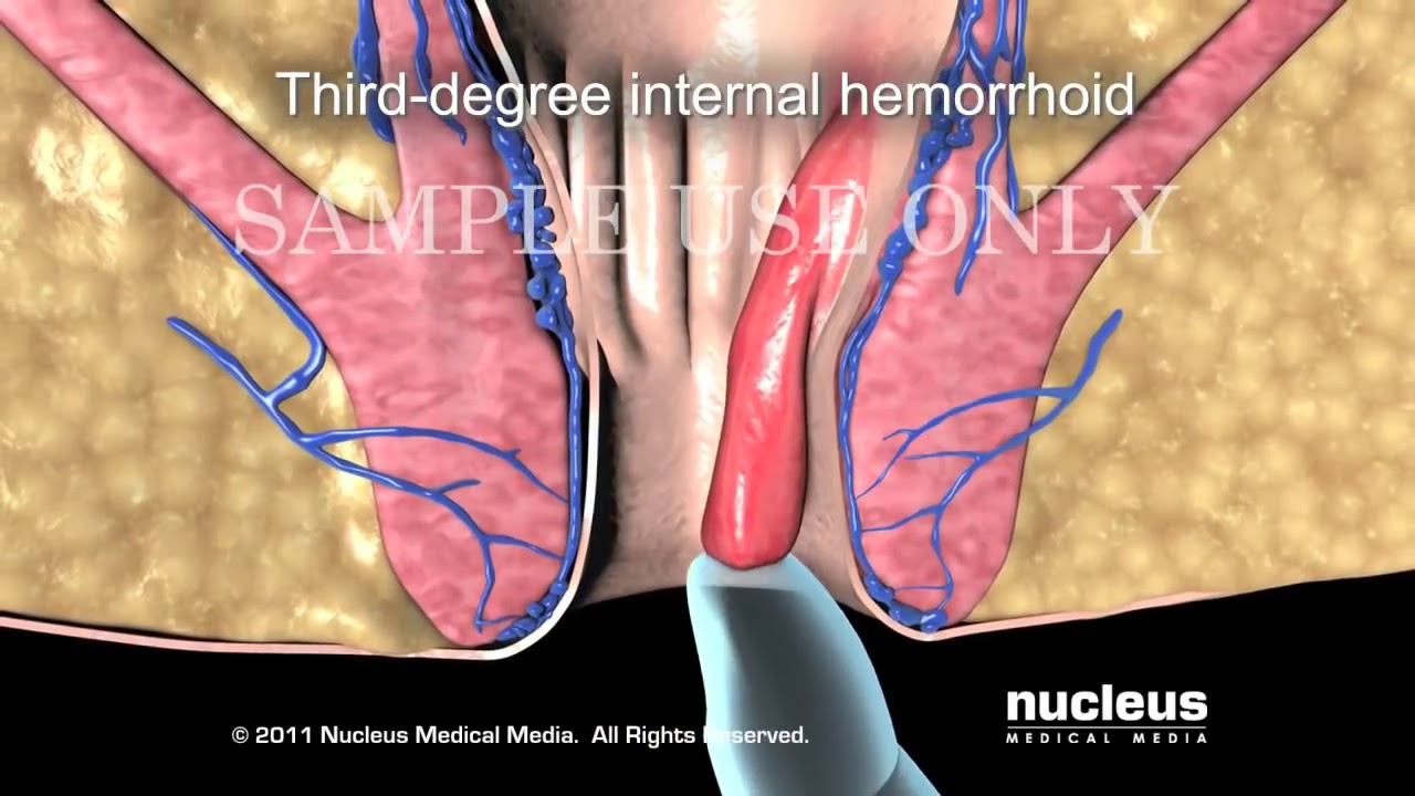 Hemorrhoid Classification System Types Of Hemorrhoid Surgery YouTube