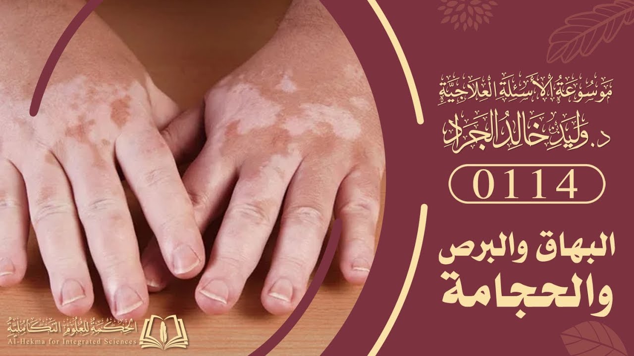 السؤال [114] [8-2]: من أين يحتجم من لديه تغير في لون جلده لا أدري هل هو بهاق أو برص ؟