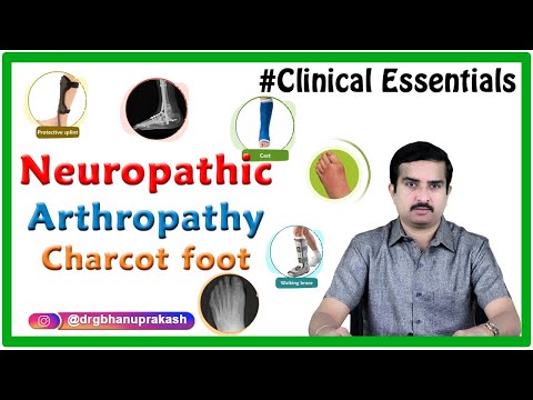 Neuropathic Arthropathy / Charcot foot - Causes, Pathogenesis, Diagnosis, Treatment