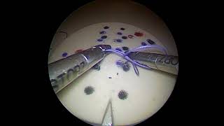 laparoscopic suturing: Slipping knot, variation 2