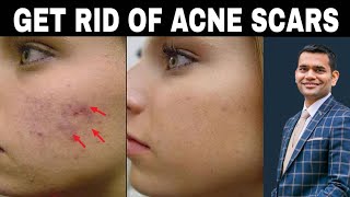 How To Get Rid Of Acne Scars Completely screenshot 2