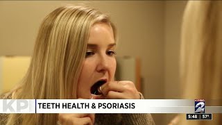 Teeth health and the connection to psoriasis