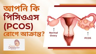 PCOS রোগের লক্ষণ । কিভাবে বুঝবেন আপনি পিসিওএস (PCOS) রোগে আক্রান্ত? Identify PCOS symptoms