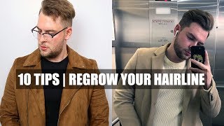 10 Quick Tips| How To Stop A Receding Hairline & Receding Hairline Regrowth