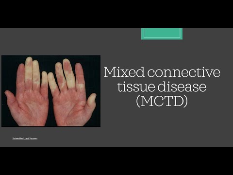 MCTD (Mixed Connective Tissue Disease) [Essential medicine]