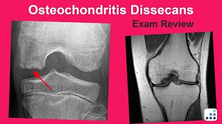 Osteochondritis Dissecans Exam Review - Mark Pagnano, MD Osteochondritis Dissecans