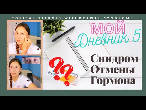 5.Дневник:Синдром Отмены Гормональной мази.|Элидел отзыв |Topical Steroid Withdrawal Syndrome