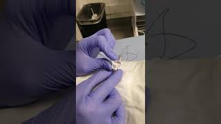 Woggle Suture removal