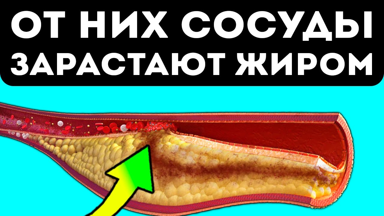 Вот какие продукты моментально превращаются в бляшки на стенках сосудов ...
