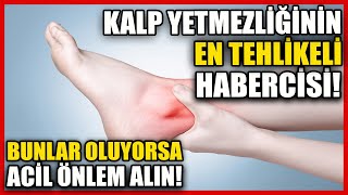 Kalp Yetmezliğinin Habercisi! Vücudunuz Bu Şekilde Ödem Tutuyorsa!