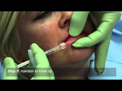 How to increase lip volume using Restylane dermal filler injections 