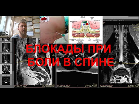Блокады при боли в спине. Паравертебральные блокады