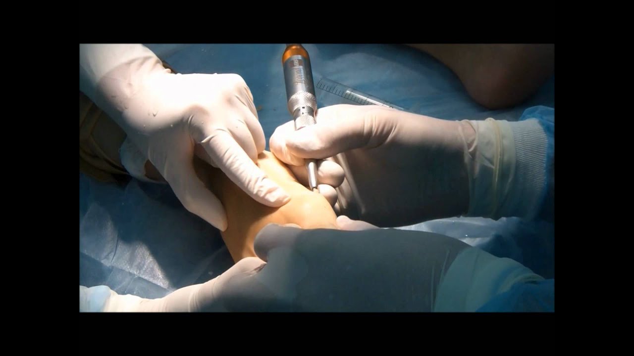 Миниинвазивная операция на стопах.