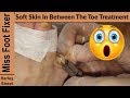 Soft Skin in between the Toe | callus in the foot | ID Corns Miss Foot Fixer Marion Yau