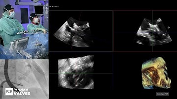 Advancing structural heart with 3D ICE and device guidance - PCR London Valves 2025
