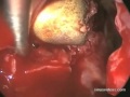 Removal of Bullet in the Eye through the Nose