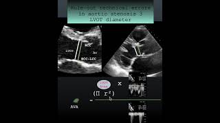 Rule out technical errors in aortic stenosis 3 LVOT diameter #echocardiography