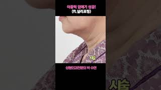 이중턱 없애기 성공 (ft.실리프팅)!? #올리고당 #실리프팅#박수연원장