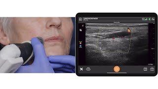 Peri-oral Vascular Mapping