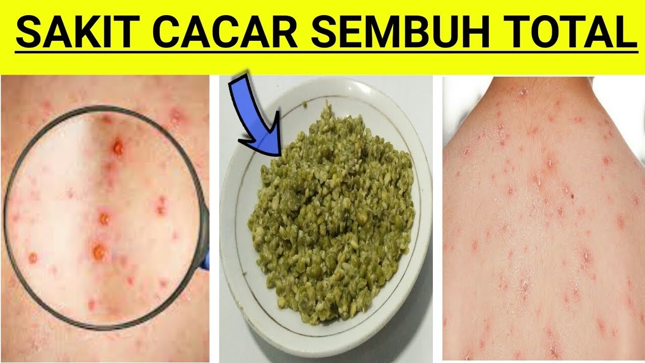 CUKUP OLESKAN!! Sakit Cacar Langsung Sembuh dan Kering Seketika ll