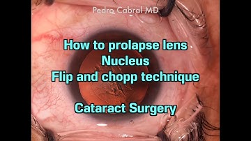How to prolapse the nucleus? Flip and Chopp technique By Pedro Cabral MD