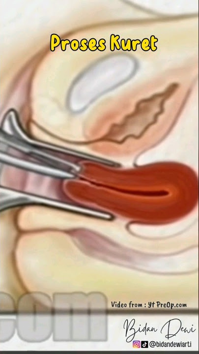 Proses Kuret