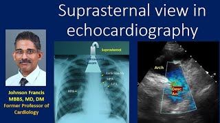 Suprasternal view in echocardiography