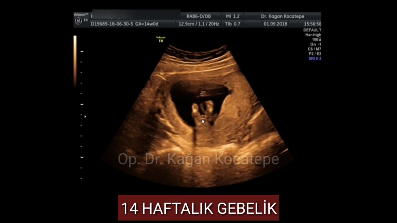 rahimde 14 haftada 3 5 ayda ultrasonda genital bolgeye bakarak erkek bebek tanisi nasil konur youtube