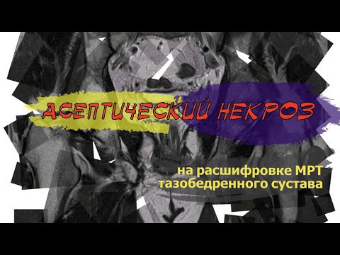 АСЕПТИЧЕСКИЙ НЕКРОЗ головки бедренной кости на РАСШИФРОВКЕ МРТ тазобедренных суставов (2 мнение)