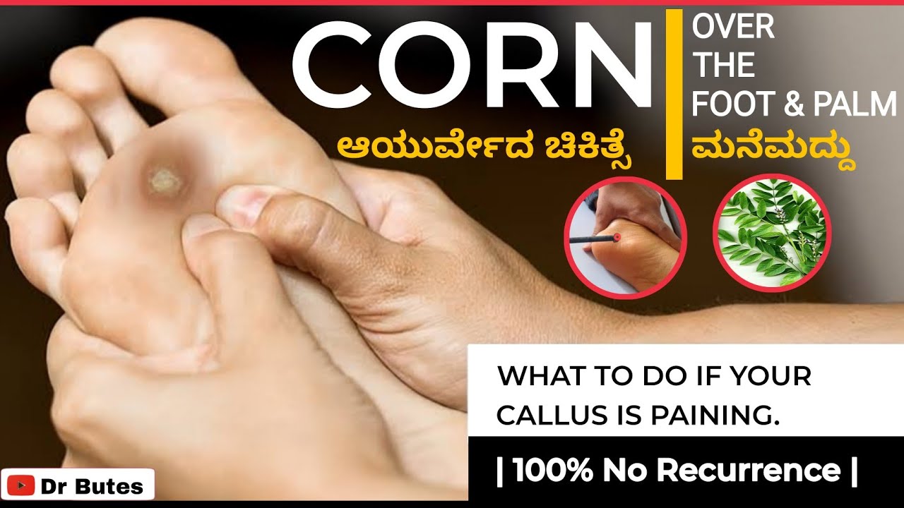How to get rid of corns on your foot permanently ? Ayurvedic home ...