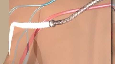 HeRO Vascular Access Device Implant Animation