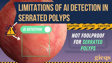 SMSA 05/2025 - "Limitations of AI Detection in Serrated Polyps" | GIEQs Teaser Video