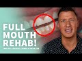 Amazing Full Mouth Rehab with Dental Implants, Veneers, and Crowns after Invisalign • Part 1 of 2